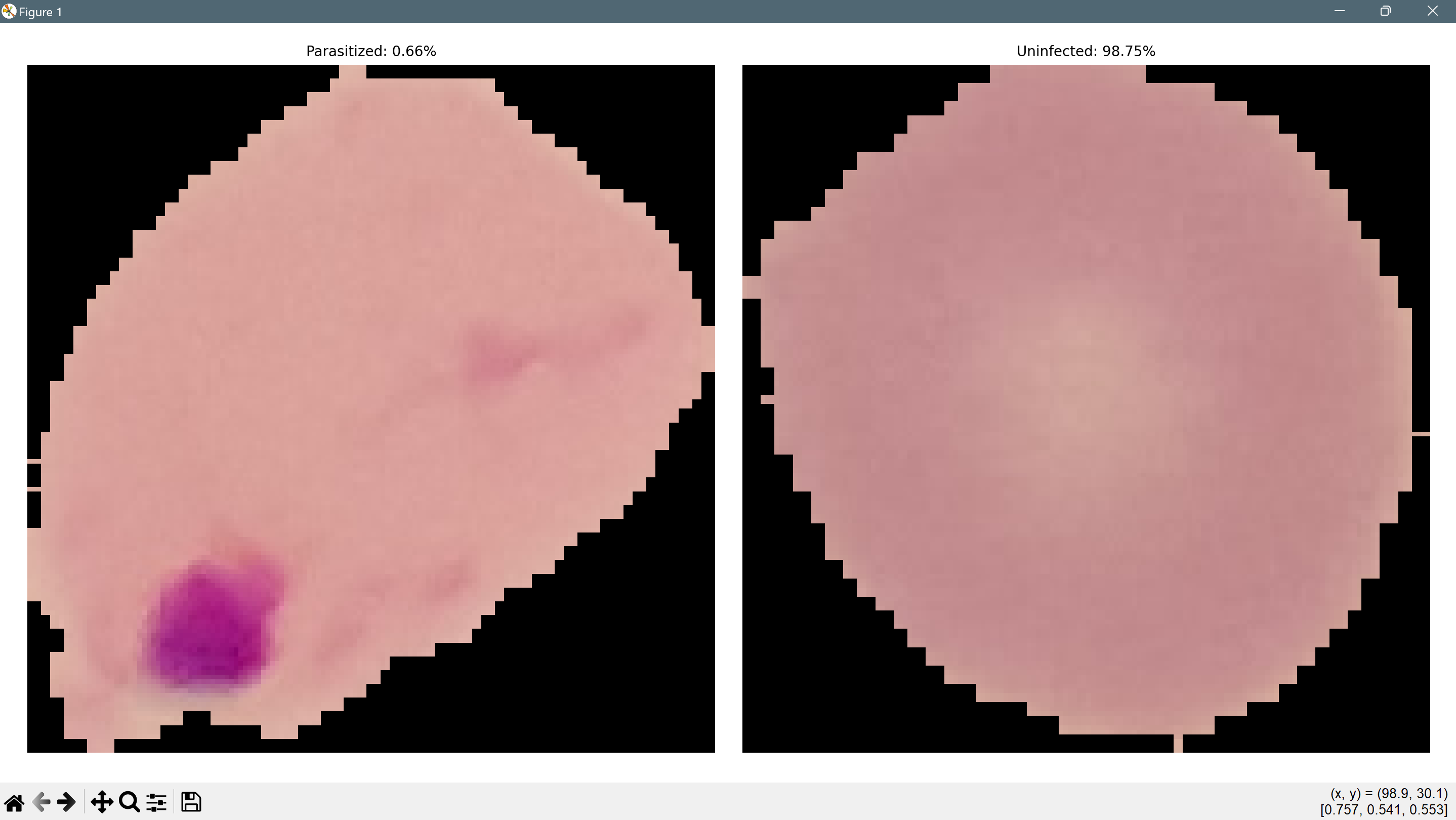 Malaria Infected Cell Image